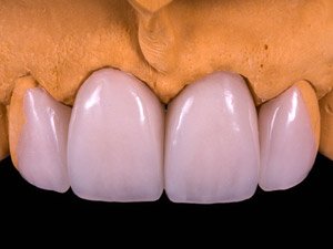 Finished Stage: Layered finished prosthesis.