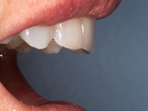 Fitted Stage: The case insitu.