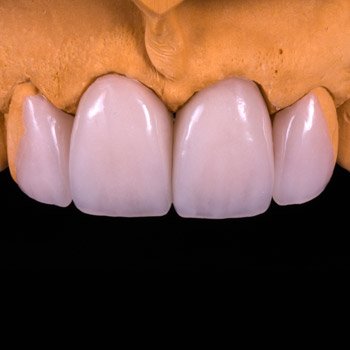 Dental Addition Veneer.