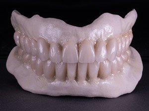 Manufacturing Stage: Pekkton frames with Lithium Disilicate on HexScan pillars.