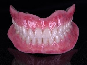 Finished Stage: Fixed / removable full arch restorations with anaxgum pink composite.