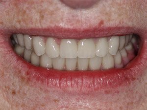 Fitted Stage: The case insitu.