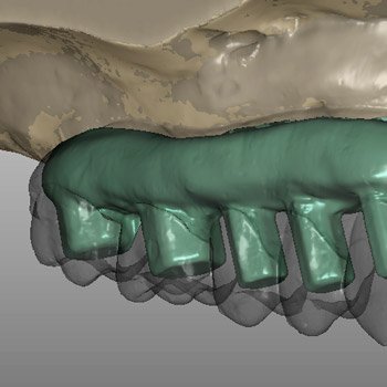 HexScan digital CAD example.