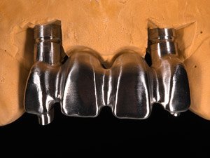 Dental Implant example 1.