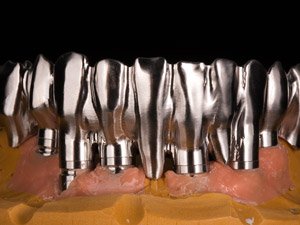 Dental Implant example 2.