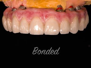 Dental Implant bonded example.