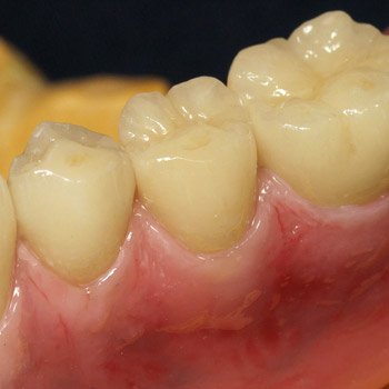 e.max crowns on a Pekkton frame with pink Anaxgum.