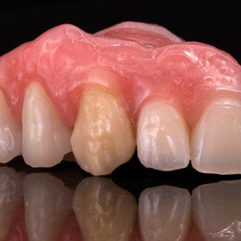 Modified denture teeth on PMMA base.
