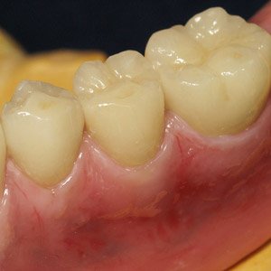 Example of e.max crowns on a Pekkton frame with pink Anaxgum.